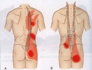 背中から腰にかけて痛みが出やすい部位を示した図