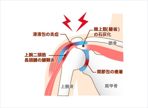 四十肩
