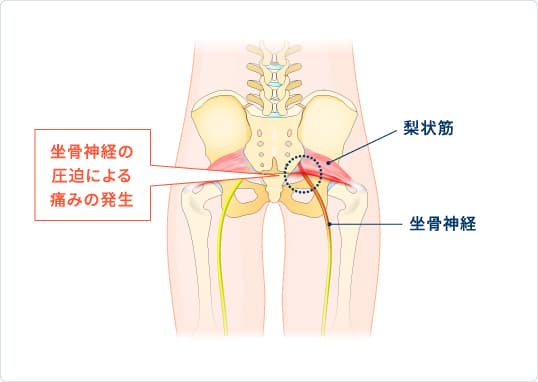 梨状筋症候群