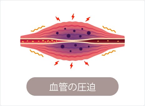 足底腱膜炎