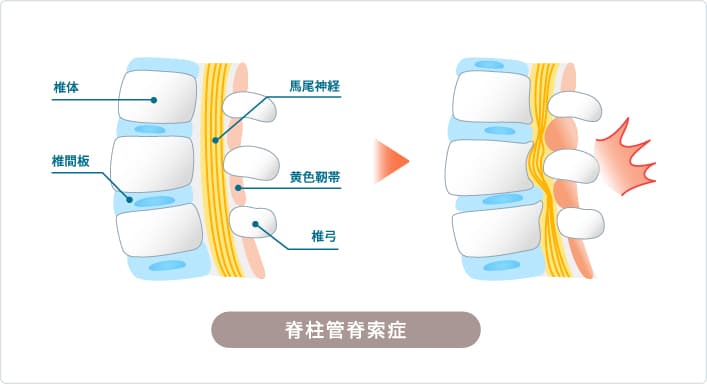 脊柱管狭窄症