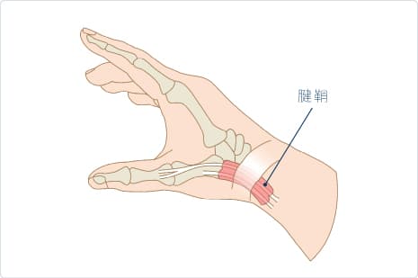 腱鞘炎