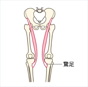 鵞足炎