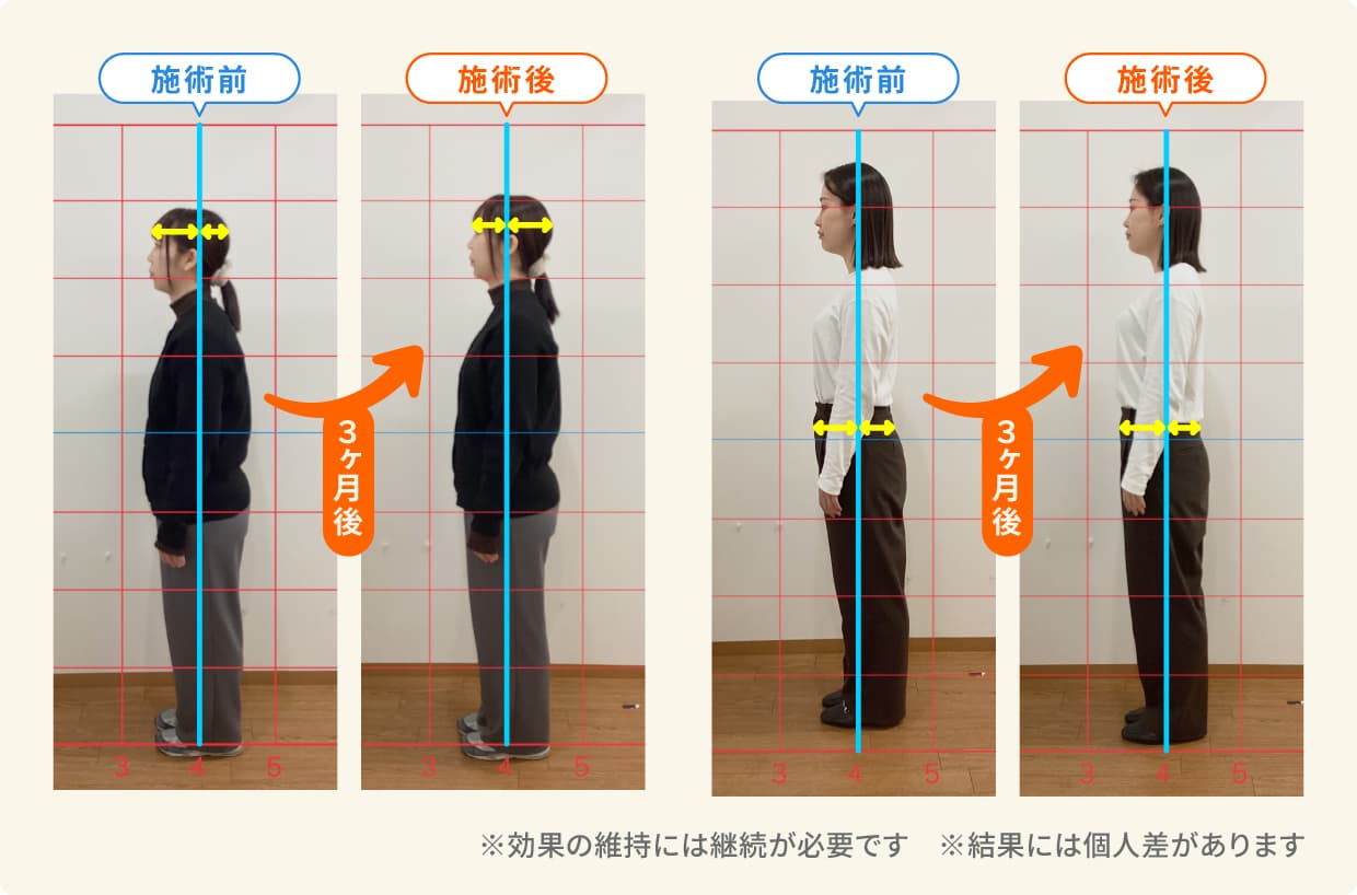 姿勢矯正による改善症例