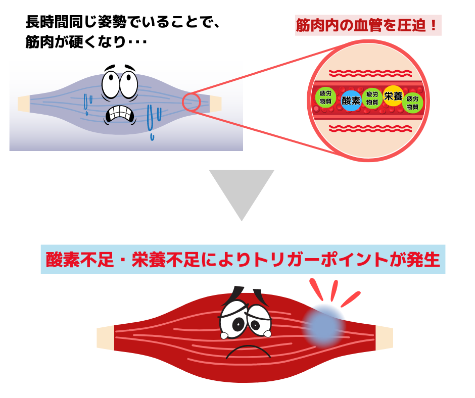 トリガーポイント注射ってどんな効果があるの？痛みはあるの？1回で終わるの？副作用は？整体との違いは？