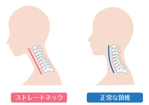 ストレートネックは整体で治る？